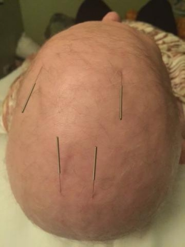 Craniopuntura para Sinusite Preço Ibirapuera - Craniopuntura para Dor de Cabeça Frontal