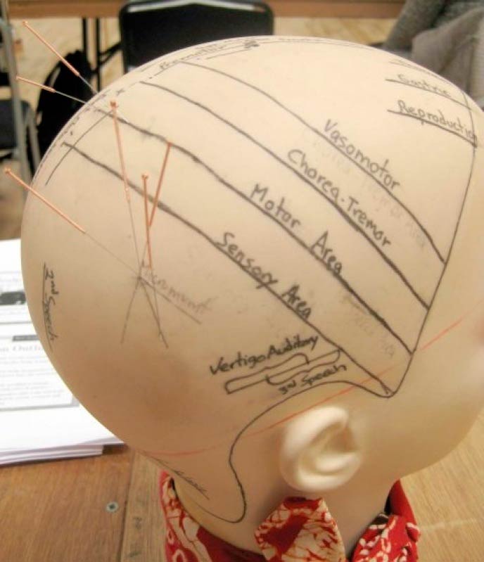 Quanto Custa Craniopuntura para Sinusite Ibirapuera - Craniopuntura para Dor de Cabeça Tensional