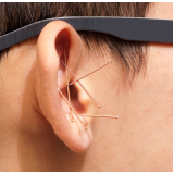acupuntura auricular com esferas Cursino