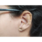 acupuntura auricular para bruxismo agendar Saúde