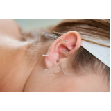 acupuntura na orelha para ansiedade Campo Belo