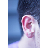 acupuntura na orelha Moema