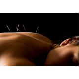 acupuntura sistêmica neiguan Saúde