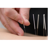 acupuntura sistêmica para insonia Campo Belo