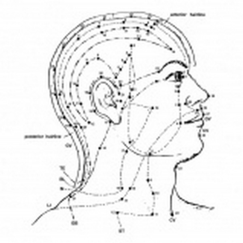 Tratamento para Dor com Craniopuntura em Sp Itaim Bibi - Craniopuntura para Dor de Cabeça Frontal
